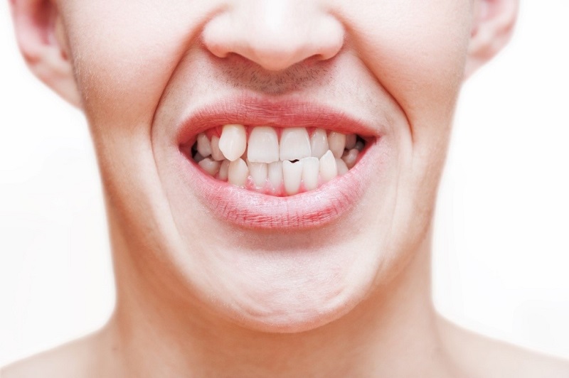 8 Negative Effects of Crooked Teeth on Oral and Overall Health | HealthSoul