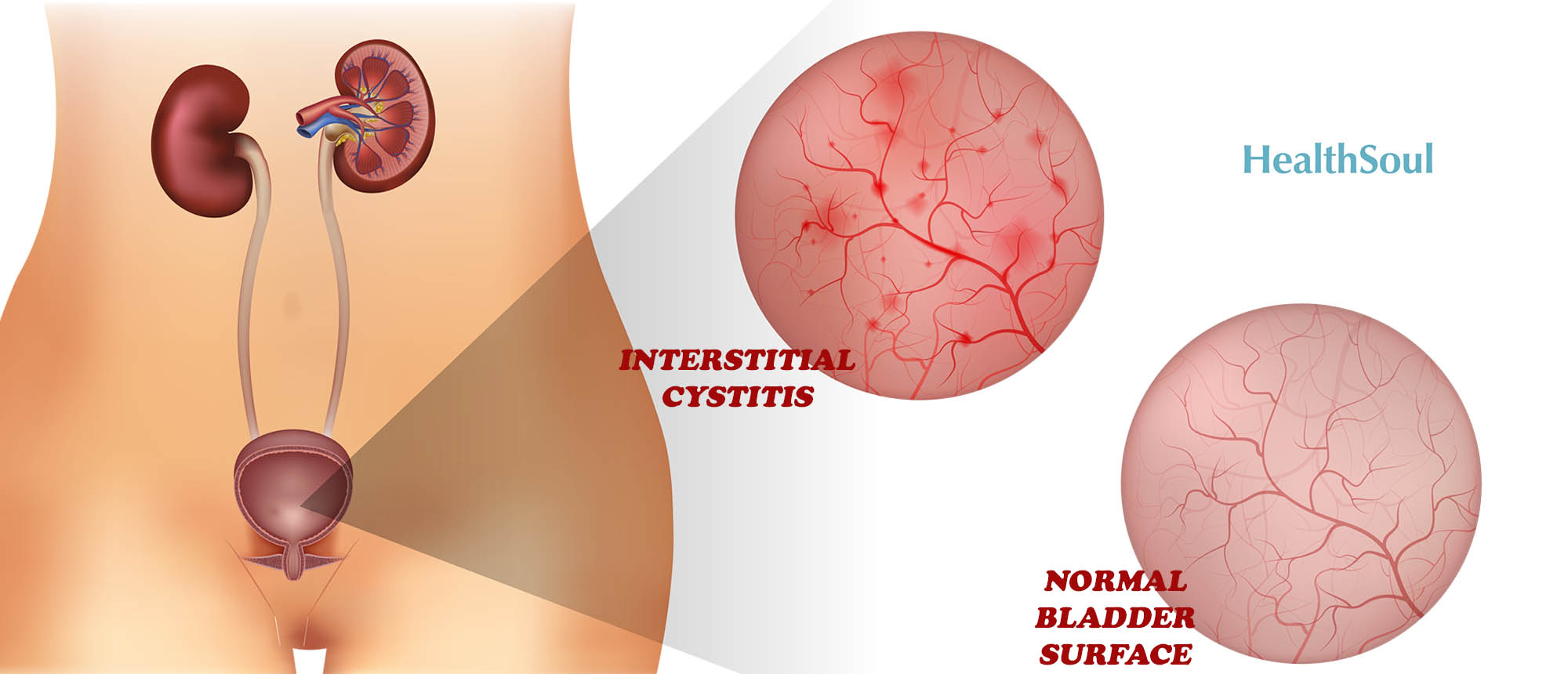 What Relieves Interstitial Cystitis? | HealthSoul