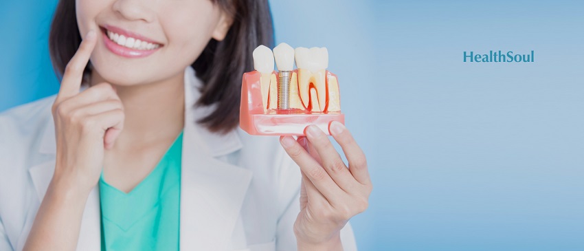 Who can do Dental Implant? | HealthSoul
