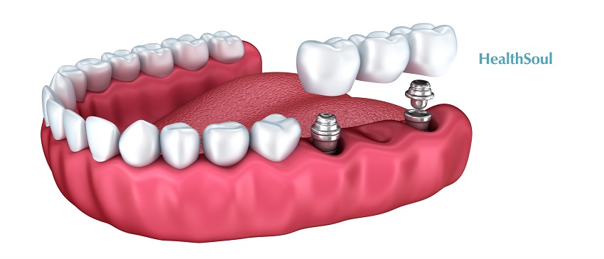Dental Implant Costs and Why They're Worth the Money | HealthSoul
