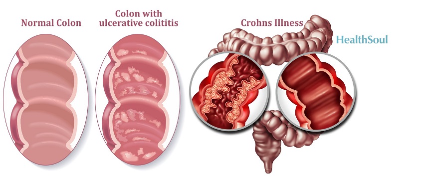 Inflammatory Bowel Disease: Crohn's Disease and Ulcerative Colitis | HealthSoul