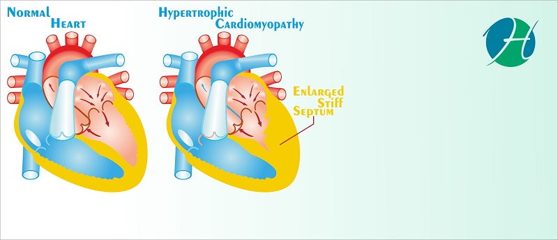 Septal Myectomy and Septal Ablation for Hypertrophic Cardiomyopathy | HealthSoul